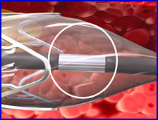 Coronary Stent Delivery & Dilatation System