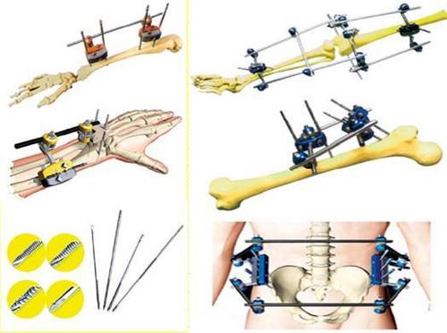 Orthopedics Implant Bone Plate - Superior Grade Material, High-Quality Manufacturing