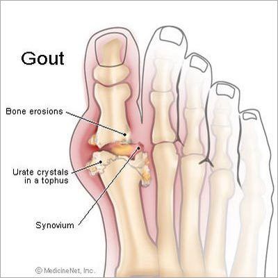 Gout Diseases Homeopathy Treatment