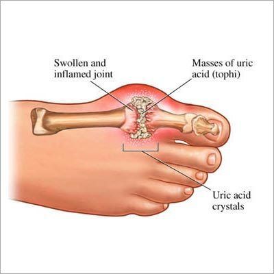 Gout Diseases Treatment