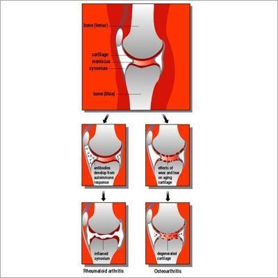 Joint Diseases Homeopathy Treatment