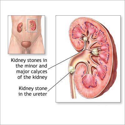Kidney Diseases Homeopathy Treatment