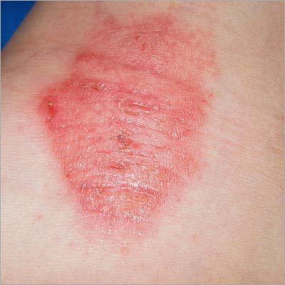 Skin Diseases Homeopathic Treatment