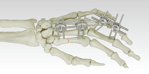 External Fixator (Metacarpus And Phanlanx)