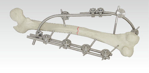 Femur Trunk External Fixation