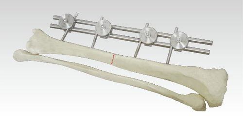 China Manufacturer Orthopedic Instrument Ao External Fixtors Tibia