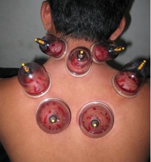 Cupping Therapy