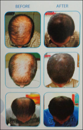 Hair Loss Treatment By TVACHA