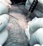 Hair Transplantation Service