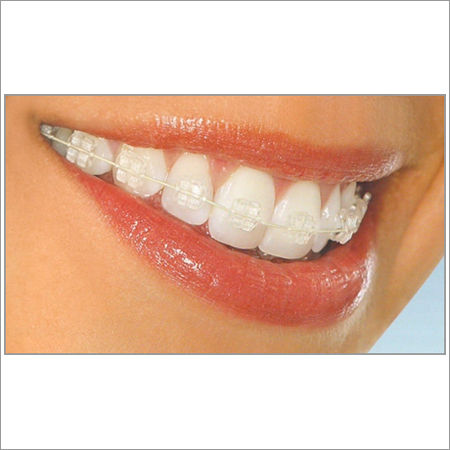 Invisible Braces Treatment