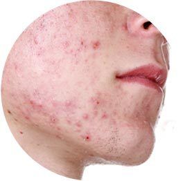 Acne Homeopathy Treatment Service