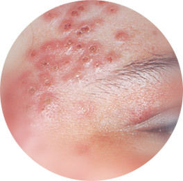 Eczema Homeopathic Treatment Service