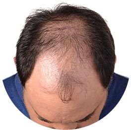 Hair Loss Homeopathic Treatment Service