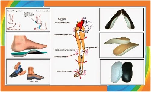 Customised Orthotic Insoles For Flat 