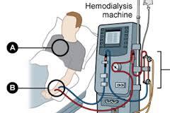 Hemodialysis Machine Capacity: 1-113 L Kg/Hr