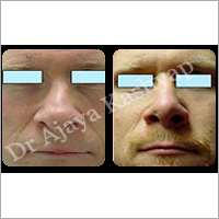 Cosmetic Nose Surgery Services By Image Clinic PVT. LTD