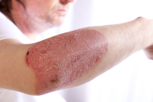 Psoriasis Treatment Service