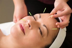 Acupuncture Therapy By Stayfit
