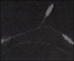 सिलिकॉन बैलून नाक पैकिंग और सक्शन