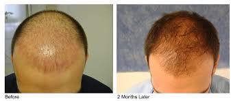 Platelet Rich Plasma For Hair Growth Services