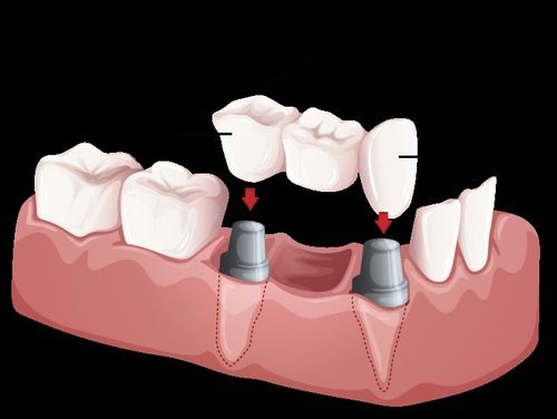 Crowns and Bridges Services For Teeth