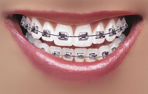 Dental Braces - High-Grade Alloy Material, Durable Design | Long-Lasting Performance, Affordable Quality