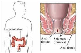 Fistula Treatment