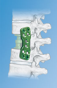 Thoracolumbar Spine Locking Plate