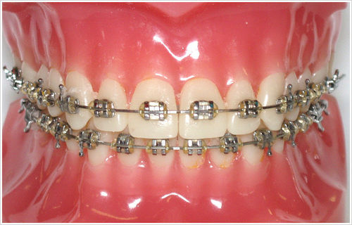 Orthodontic Braces