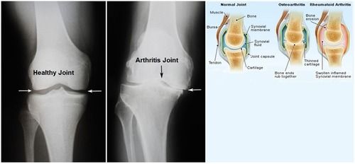 Arthritis Homeopathy Treatment Service