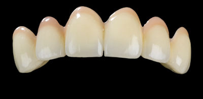 Gingiva Ceramics