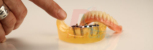 Implant Prosthesis