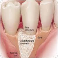 Dental Bone Graft Material