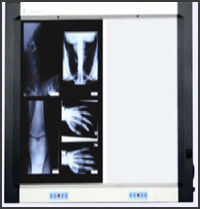 X Ray Viewing Screen - Opaque Acrylic Sheet, High Frequency Fluorescent Lamps, Durability & Flicker Free Luminance, Hygienic & Easy to Clean