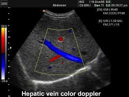 Color Doppler