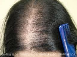 Natural Hair Patch