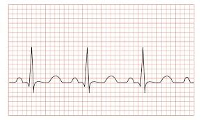 NORTH ECG Paper