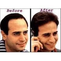 Hair Bonding Service By Perfect Hair Replacement Center