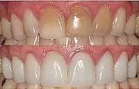 Tooth Discoloration Treatment Service