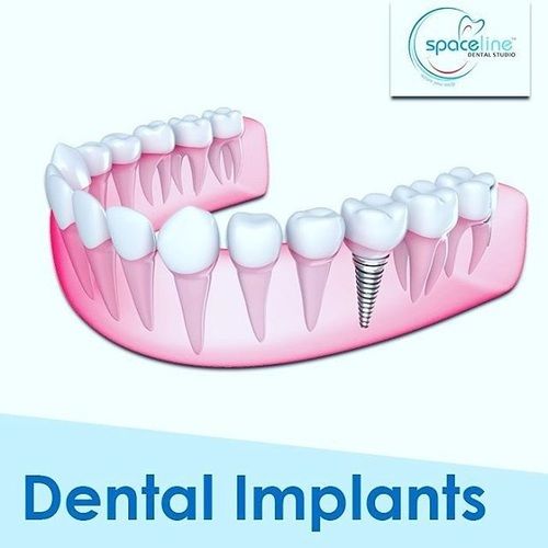 Dental Implant Service