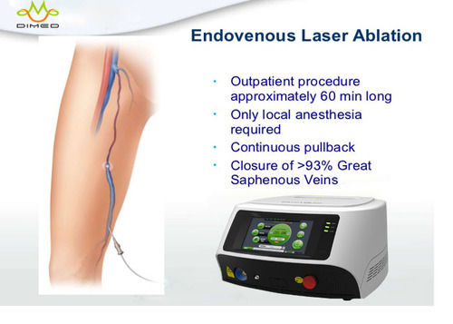 Endovenous Laser Therapy Treatment For Varicose Veins In Legs At Best