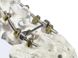 spinal implants