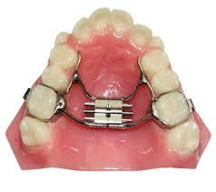 Stainless Steel Dental Orthodontic Braces at Rs 500/piece in Bengaluru