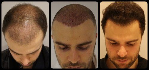 Glass Hair Transplant Service