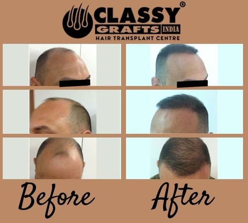 Cost Effective Hair Transplant Service