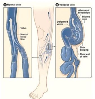 Varicose Veins Treatment Service