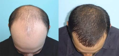 Hair Cloning Treatment Service