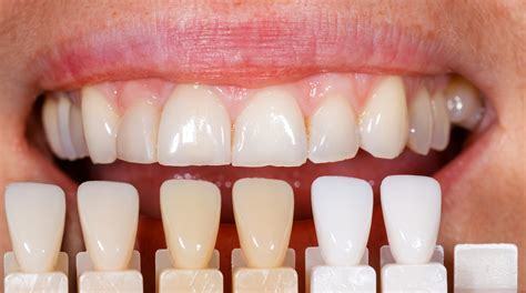 Plastic Veneers