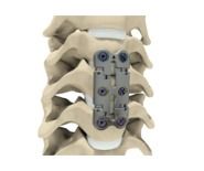 Dyna Tran Anterior Cervical Plating System Cas No: 16 R 1653