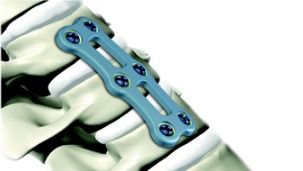 Reflex Hybrid Anterior Cervical Plating System